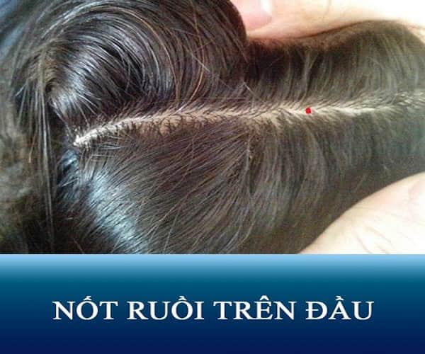 Nốt ruồi ở đỉnh đầu có ý nghĩa gì?